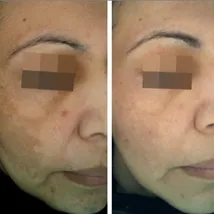 cosmelan-peel-before-and-after 7 cosmelan peel before and after