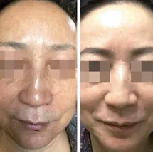cosmelan-peel-before-and-after2 8 cosmelan chemical peel before and after