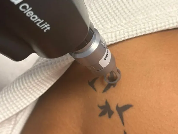laser tattoo removal in nairobi