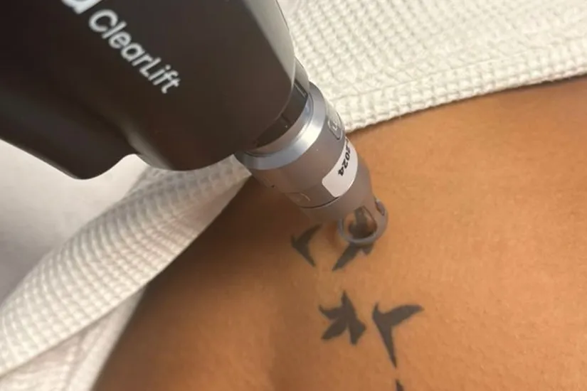 Laser Tattoo Removal 1 laser tattoo removal in nairobi