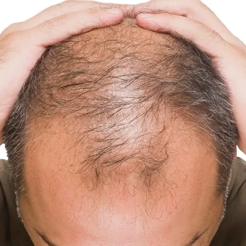 prp hair restoration in kenya