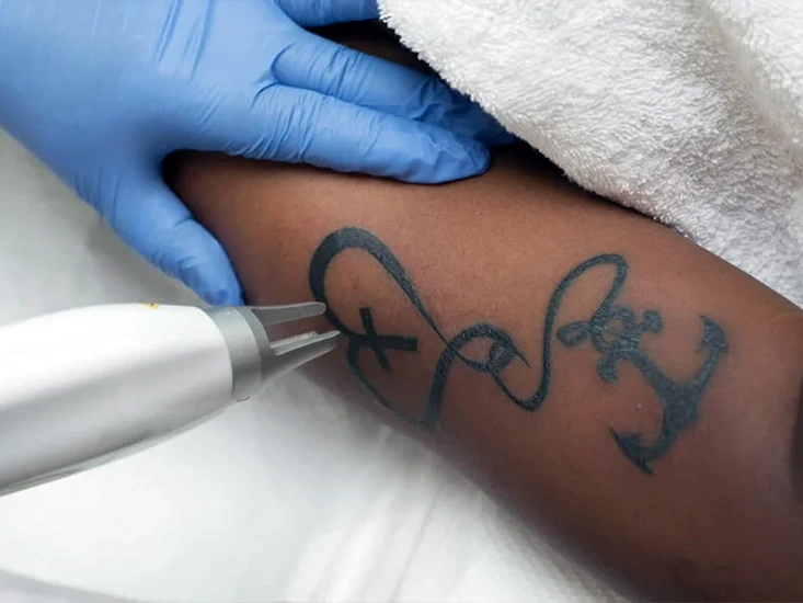 laser tatoo removal in kenya