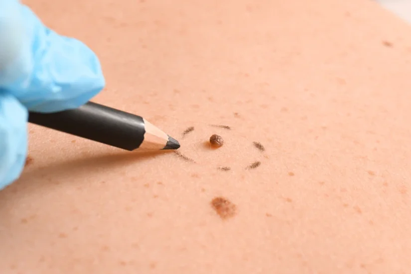 skin cancer mole mapping kenya uai