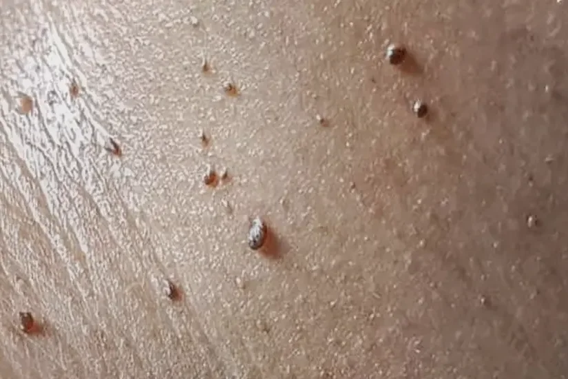 skin tags removal in nairobi